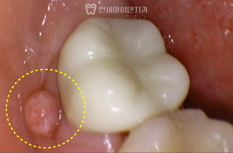 재신경치료&임플란트 증례: 잇몸 여드름