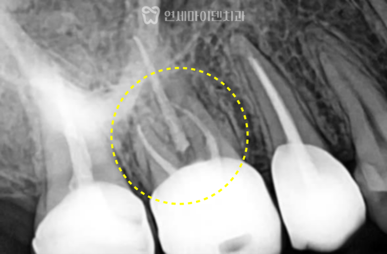 재신경치료 7년 증례: MB2 신경관