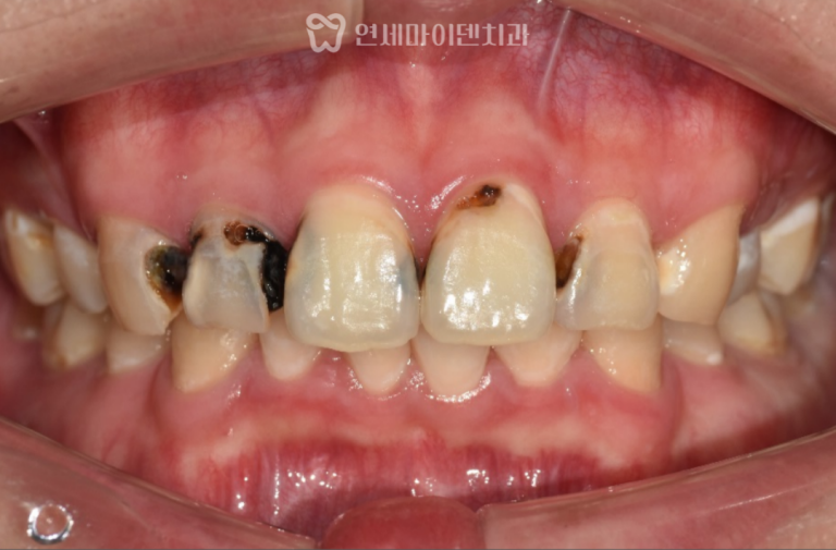 앞니 신경치료 3년 증례: 앞니 충치