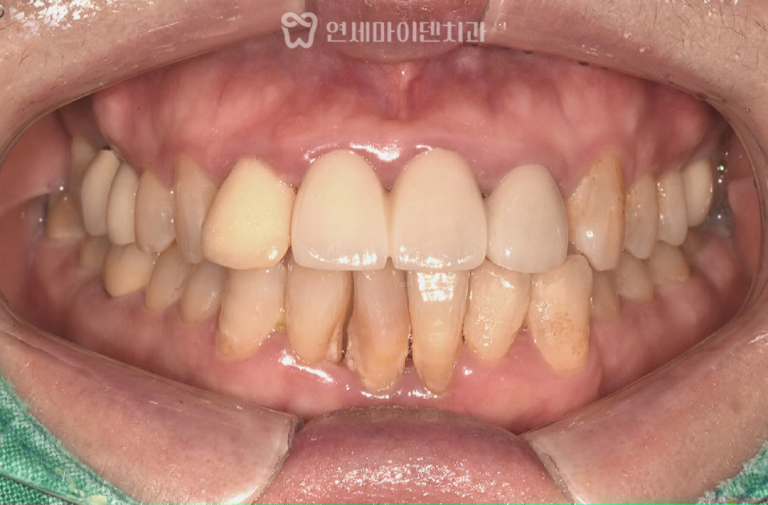 60대 중장년층 치아교정: 치주환자 발치교정 증례