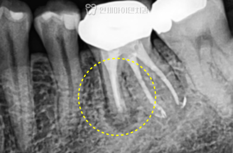 해외출국 임플란트: 치근단절제술(Apico) 염증재발