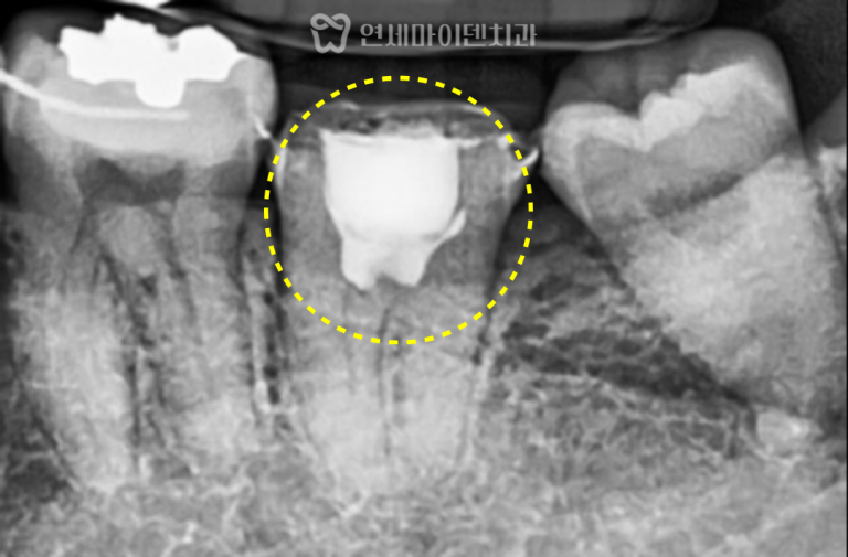 VPT 생활치수치료 증례: 상부 치아크랙