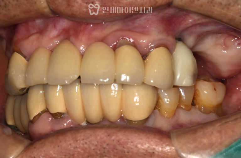 임플란트 재수술 증례: 70대 임플란트
