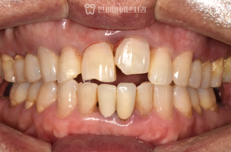 치아정복술 증례: 외상으로 함입된 앞니