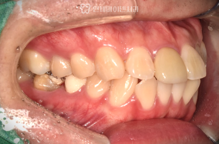 돌출입 치아교정: 발치교정 전후