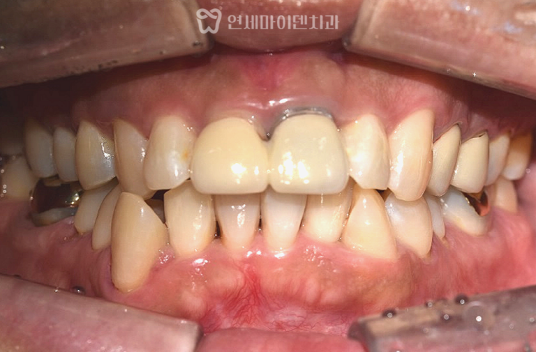 앞니 재신경치료·실활치미백 증례: 스플린트 크라운
