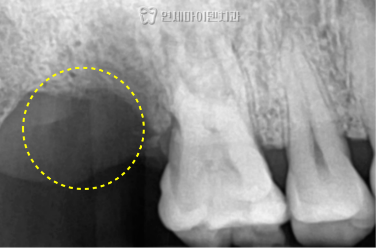상악동염 임플란트 증례: 상악동 거상술
