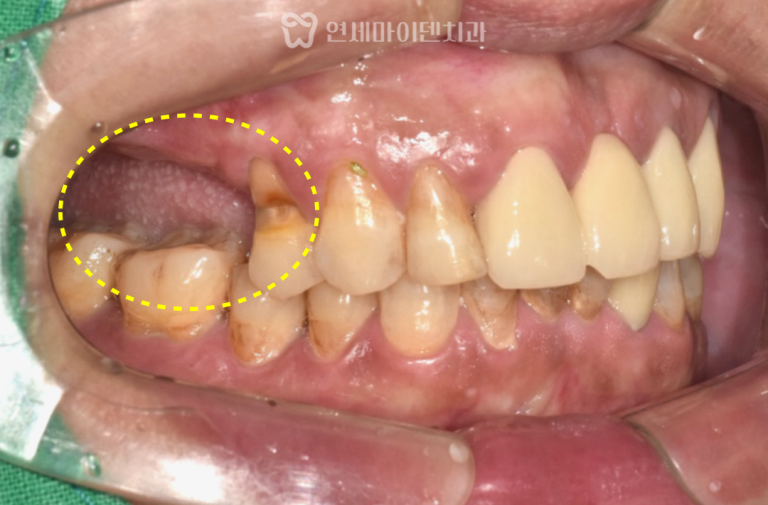 당뇨·고혈압 환자 임플란트 6년 증례: 아스피린 복용 시