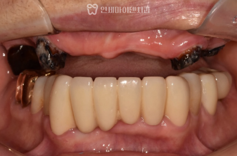 전체 임플란트 증례: 돌출 앞니 개선