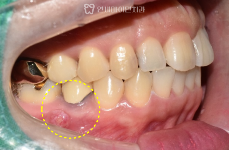 재신경치료 6년 증례: 잇몸 고름과 변색