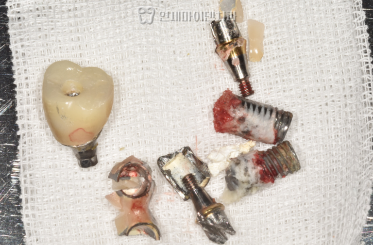 임플란트 재식립 증례: 임플란트 주위염