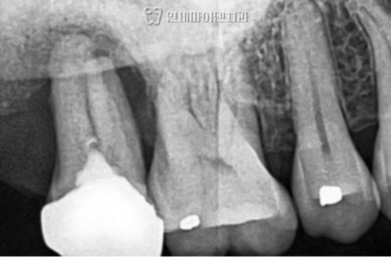 임플란트 4년 증례: 임플란트 가격 차이나는 이유