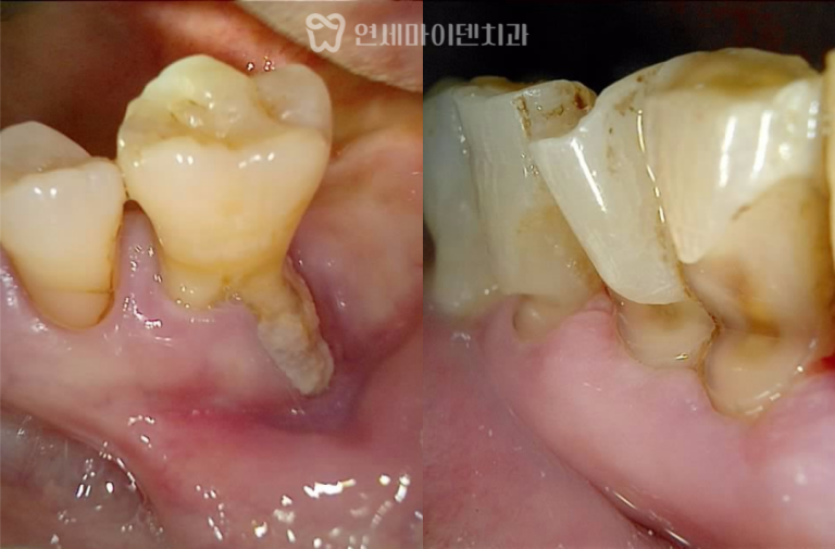 어금니 임플란트 증례: 상악동 거상술, 뼈이식 동반