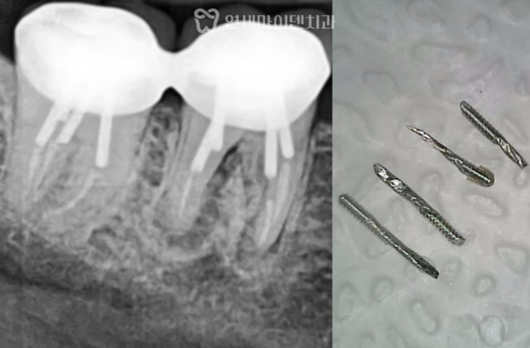 치근단염증 재신경치료 증례: 포스트 4개 제거