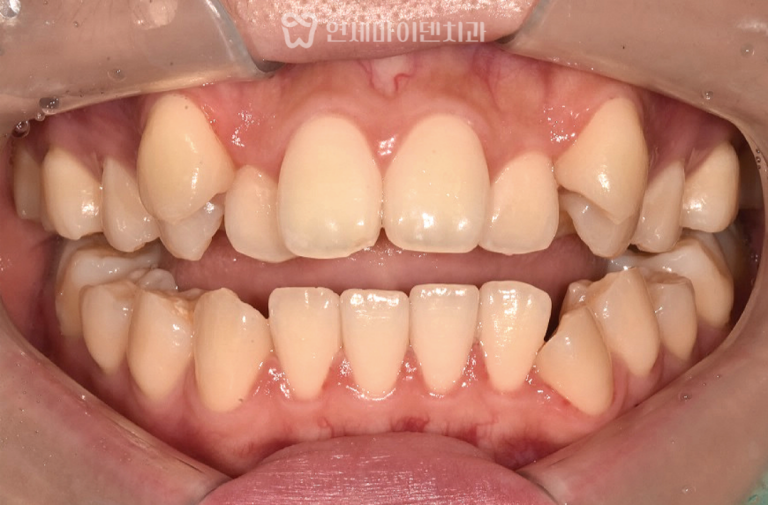 개방교합 치아교정 증례: 발치교정