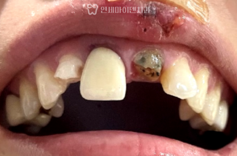 외상 앞니 재신경치료 증례: 부러진 치아 보존