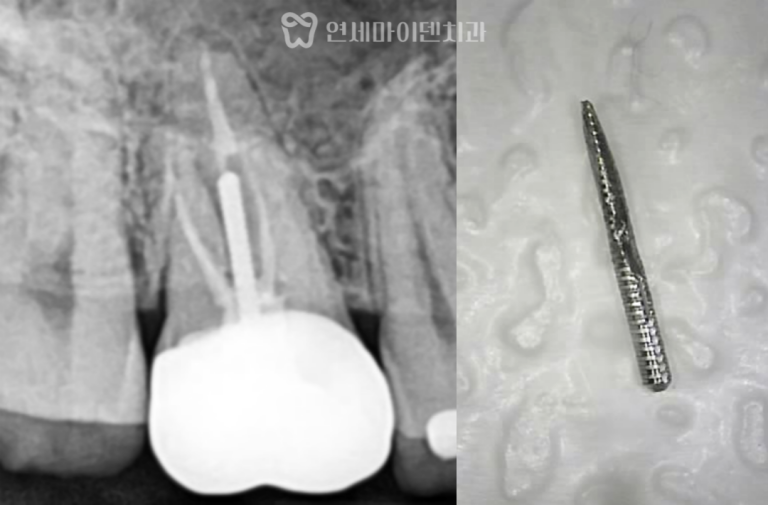 재신경치료 3년 증례: 금속포스트 제거