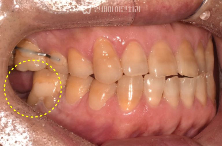 어금니 임플란트 3년 증례: 자연치 보존
