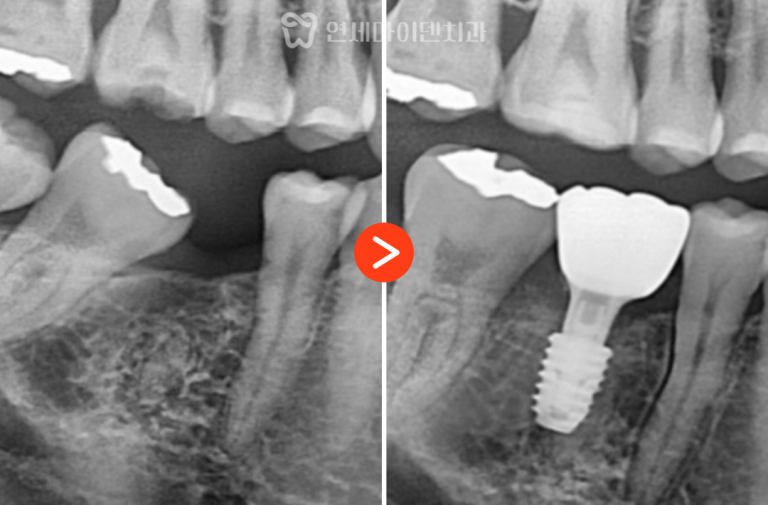 부분교정·임플란트 협진 증례: 쓰러진 어금니
