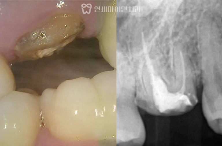 재신경치료 증례: 부러진 어금니 보존
