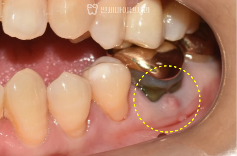 발치 즉시 임플란트 증례: 잇몸여드름, 치근파절