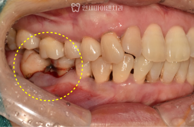 발치즉시임플란트 3년 증례: 잇몸출혈, 어금니파절