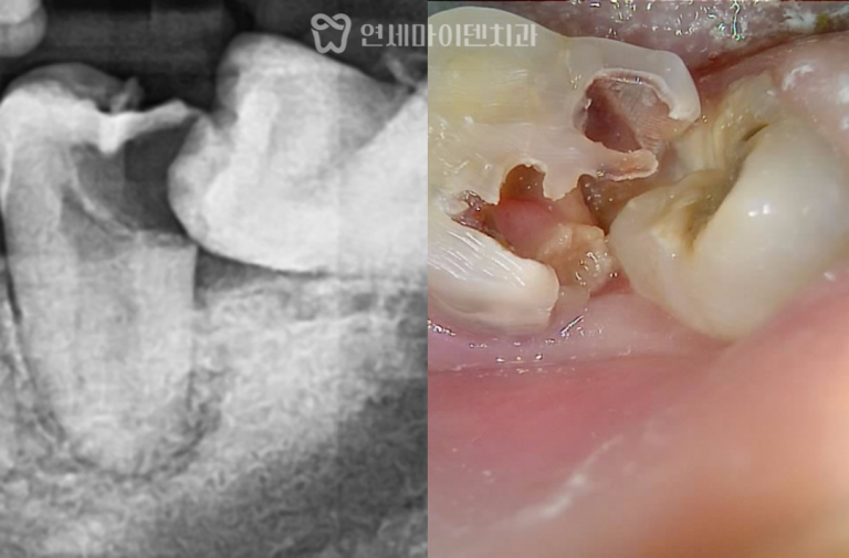 사랑니 발치, 재신경치료 증례: 사랑니 충치