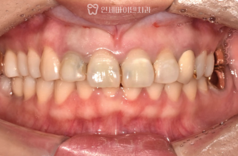 앞니 재신경치료&실활치미백 증례: 포스트 제거