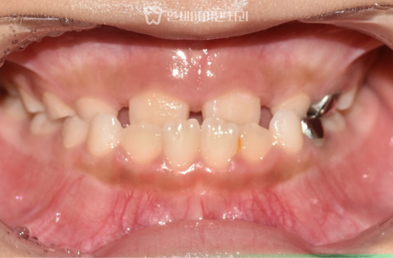 어린이 치아교정 증례: 반대교합