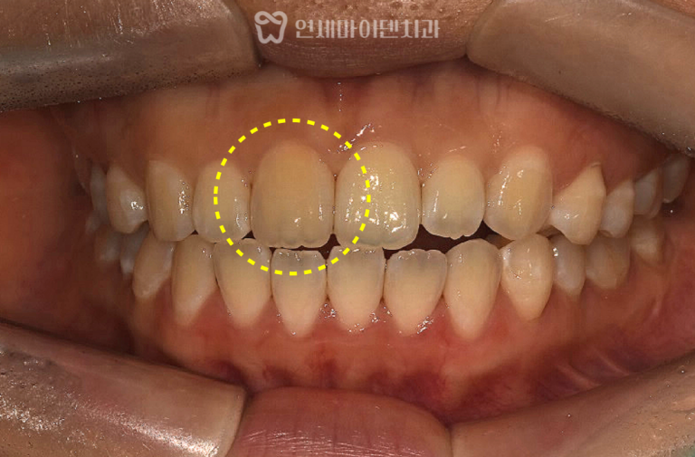 앞니 신경치료, 실활치미백 증례: 크라운 없이 레진수복