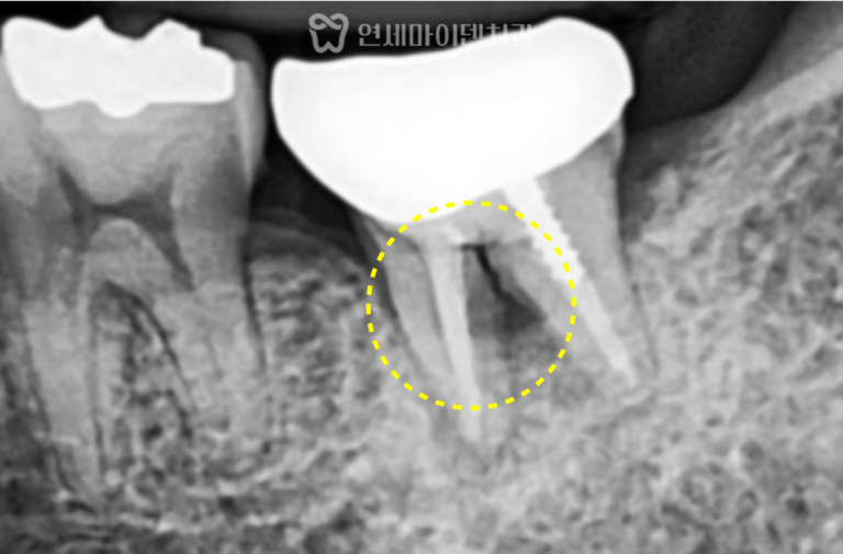 발치즉시 임플란트 증례: 어금니 흔들림