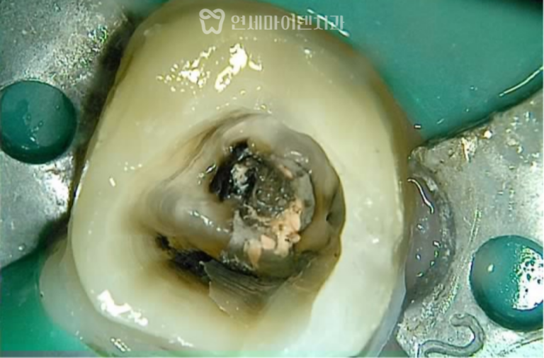 재신경치료 증례: J자 염증