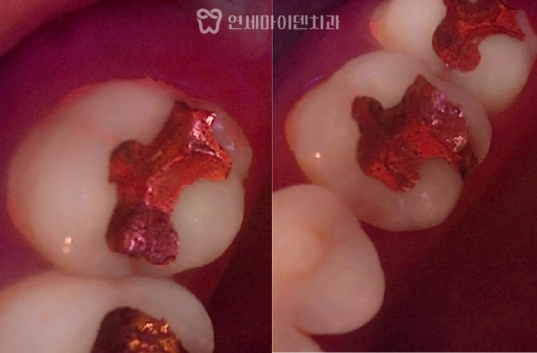 크랙치아 신경치료 증례: 이시림 원인