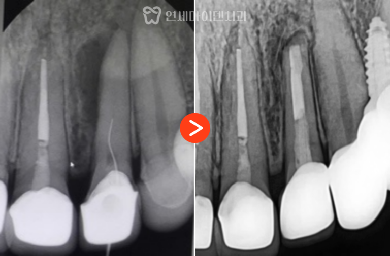 앞니 치근단절제술 증례: J자 염증