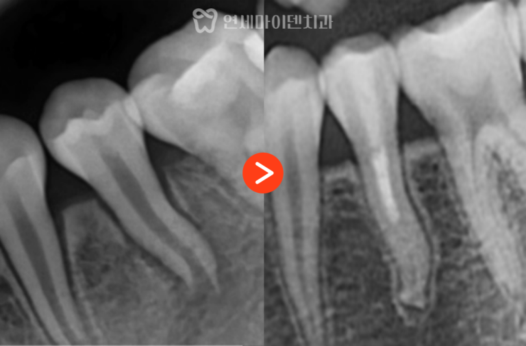 치근첨 형성술 3년 증례: 성장기 신경치료