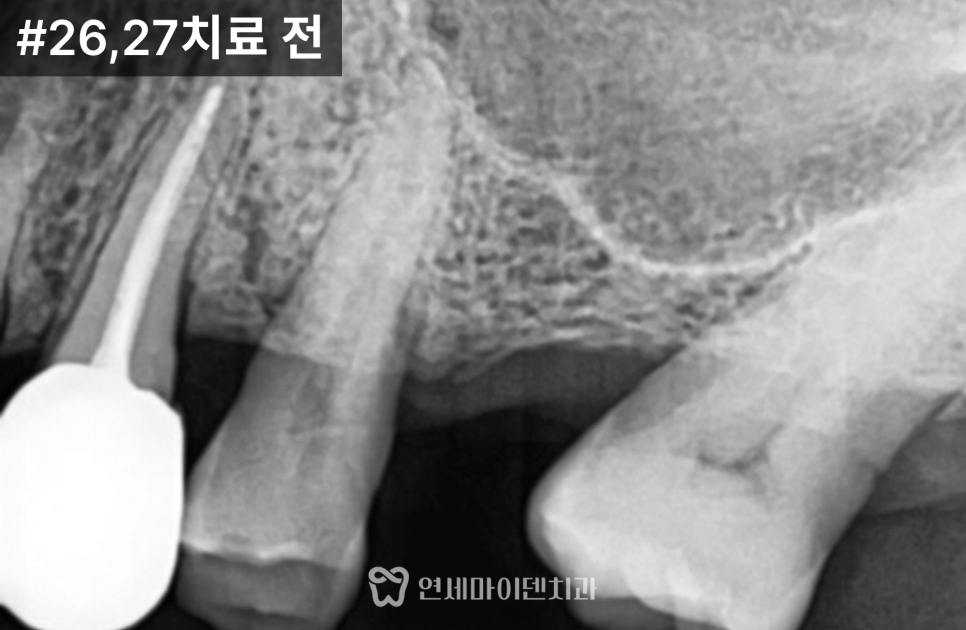상악동 거상술 임플란트 증례: 측방 및 치조정 접근법