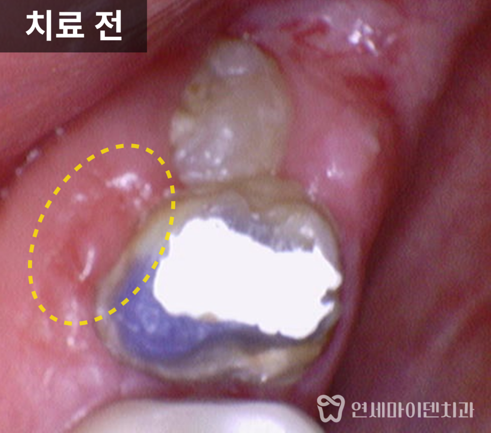미세현미경 재신경치료 증례: 타치과 발치 진단 치근단 농양